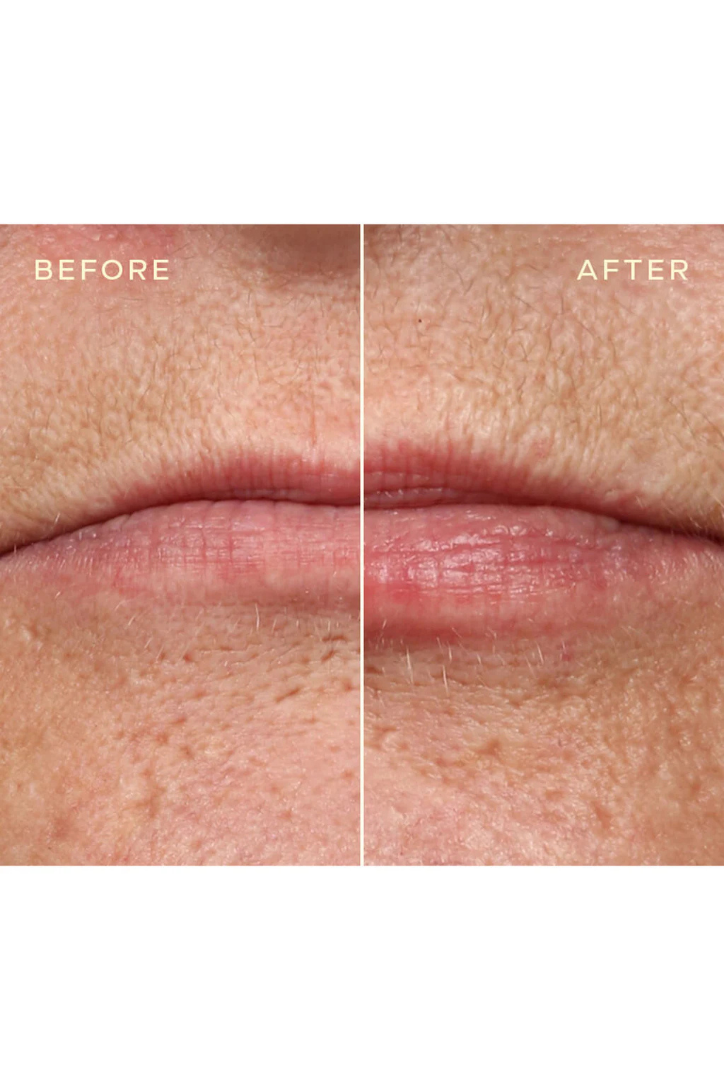 Lip Filler Refill