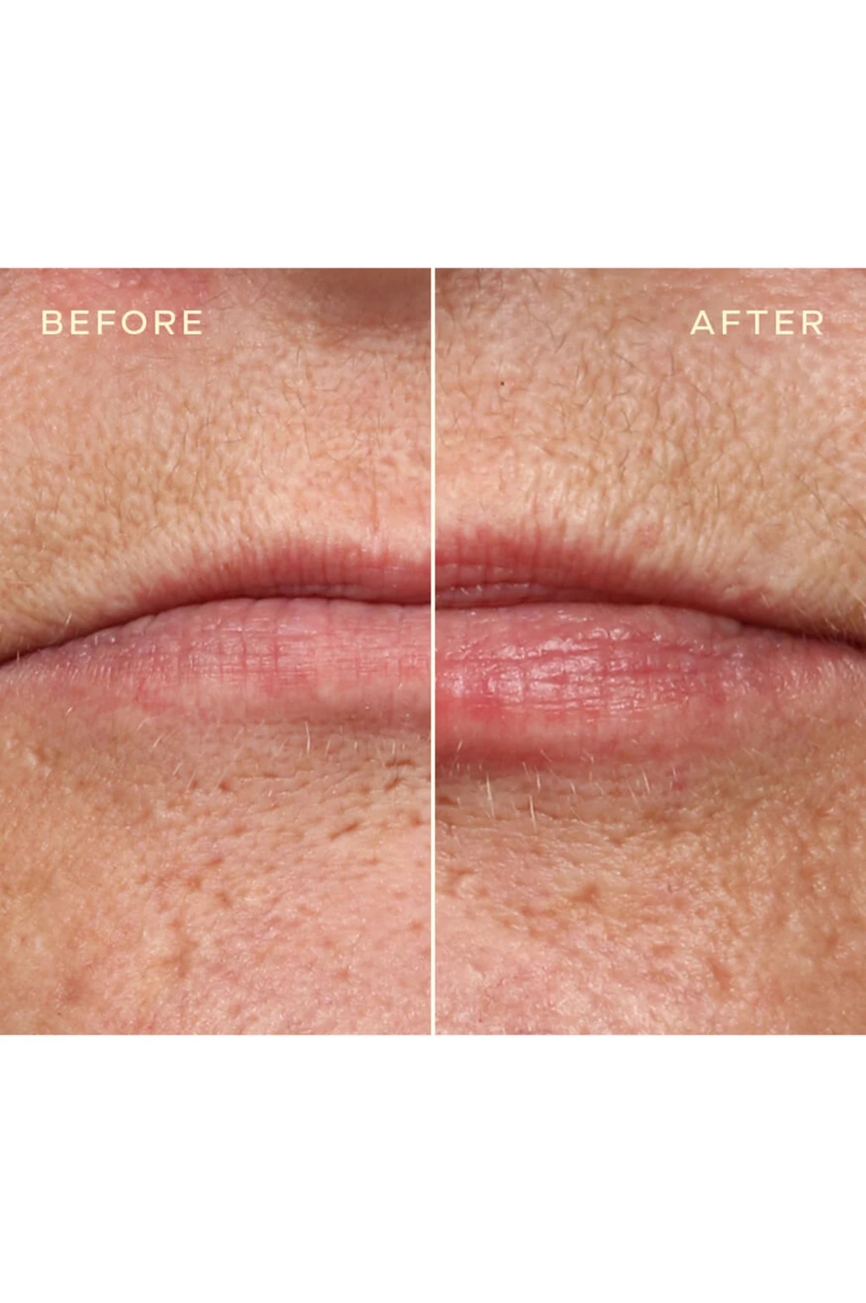 Lip Filler Refill