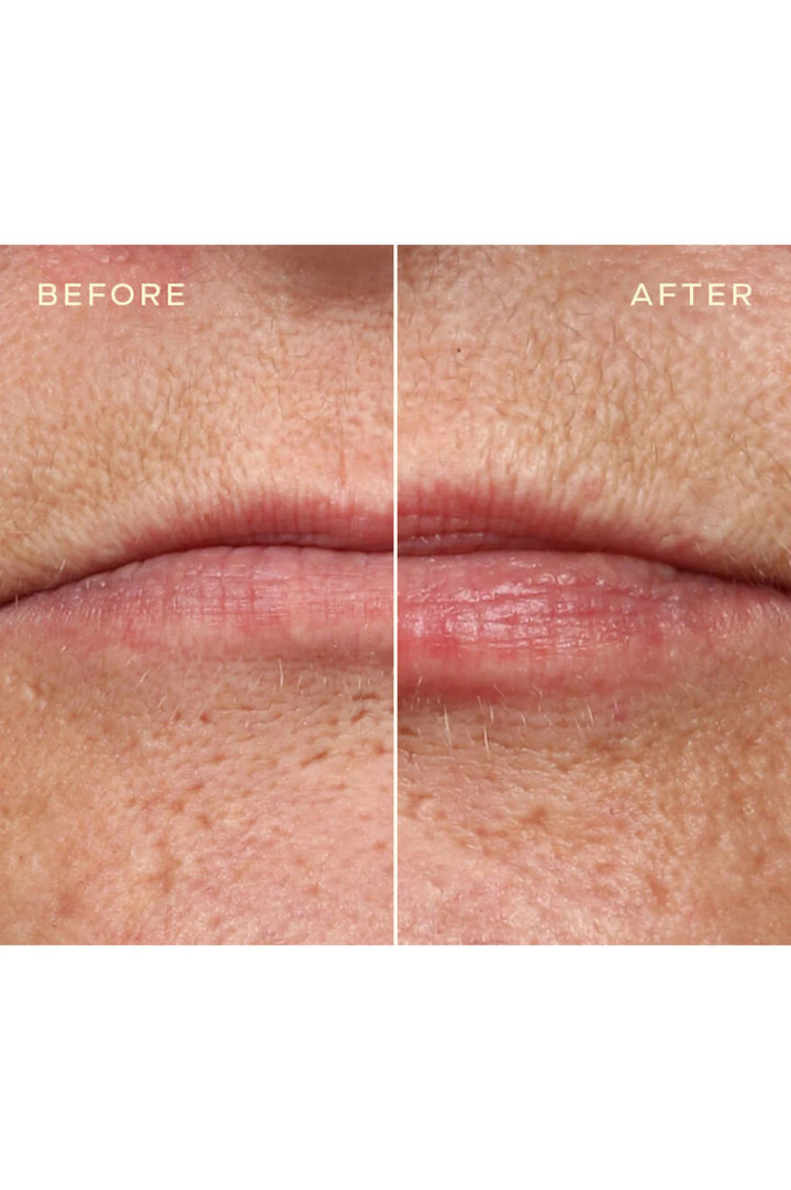 Lip Filler Refill